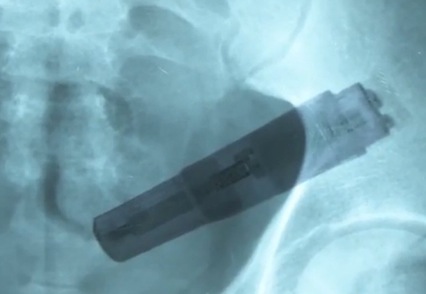 Man Gets Vibrator Stuck in Large Intestine On 'Sex Sent Me To The E.R.' (NSFW)
