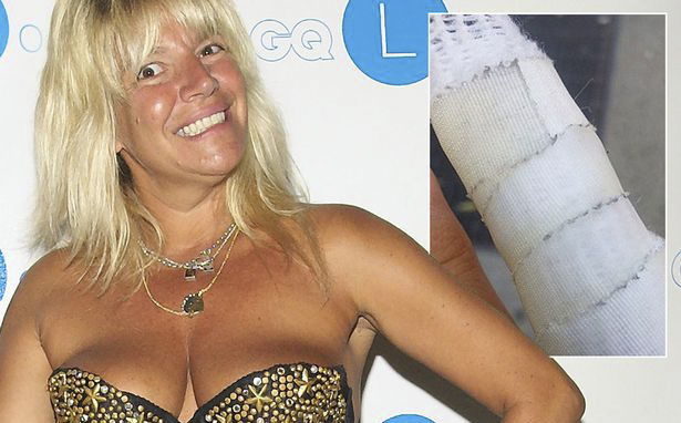 Ex-porn star Robin Byrd treated for rabies after being attacked by a raccoon