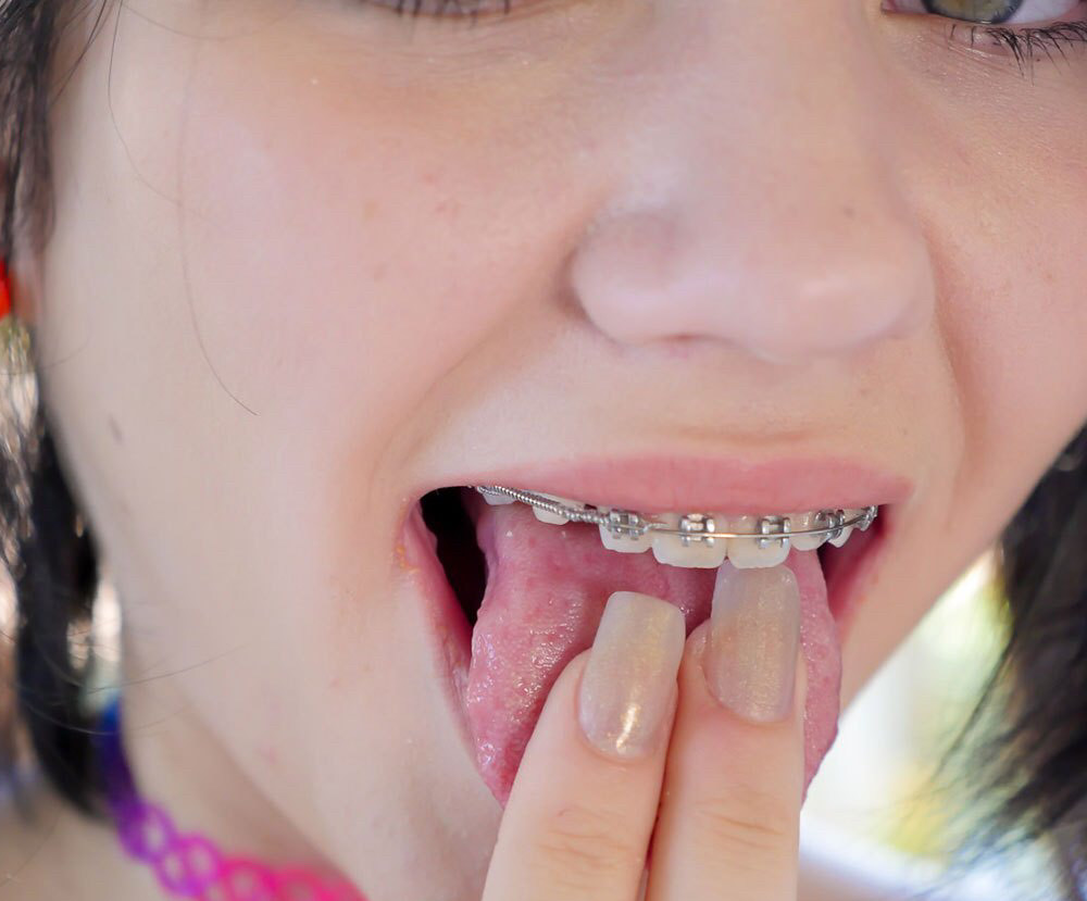 The Hottest Cam Girls with Braces - TRPWL.